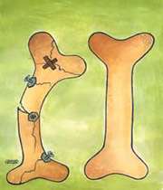 پوکی استخوان