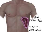 طحال بزرگ شده
