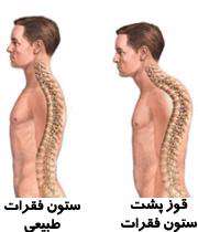 خمیدگی شانه ، قوز پشت