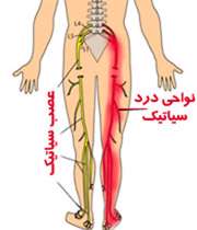 کمر درد سیاتیک