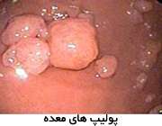 پولیپ های معده