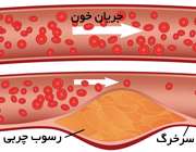 چربی خون بالا