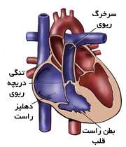 تنگی دریچه ریوی قلب