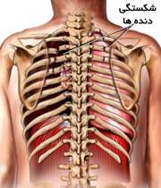شکستگی دنده های قفسه سینه