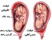 جفت سرراهی