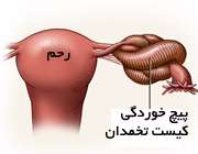 پیچ خوردن کیست تخمدان