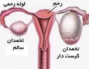 کیست تخمدان