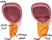 غده پروستات در مردان