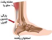 پارگی تاندون ساق پا