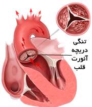 تنگی دریچه آئورت قلب
