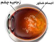 اجسام شناور داخل زجاجیه چشم