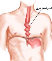 گرفتگی عضلات مری
