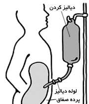 دیالیز صفاقی