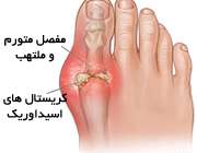 اسید اوریک خون