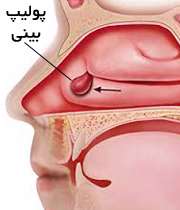 پولیپ بینی