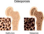 ہڈیوں کی کمزوری ( osteoporosis )
