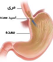 ریفلاکس اسید معده به مری