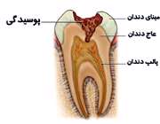 دندان پوسیده