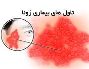 بیماری زونا