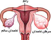 سرطان تخمدان