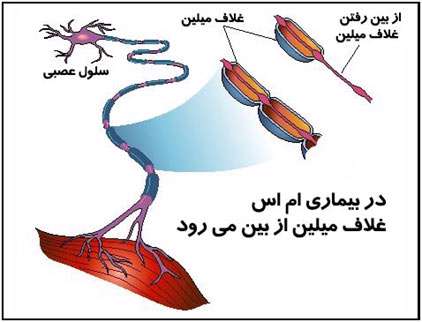 بیماری ام اس ناشی از استرس