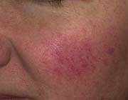 قرمزی پوست، جوش پوست، رزاسه، روزاسه