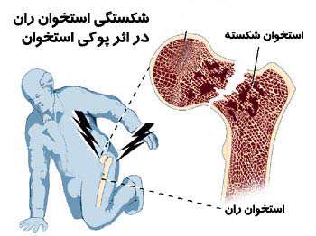 درمان پوکی استخوان