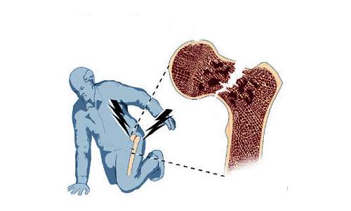 Перелом бедра рисунок