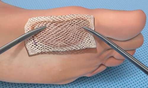 مشکلات پای دیابتی (3) مشکلات پای دیابتی (3)