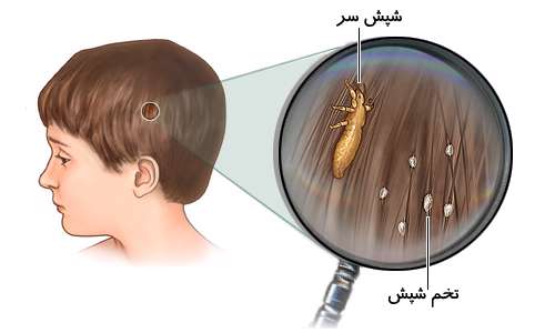 شپش سر کودکان