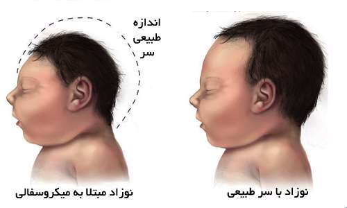 میکروسفالی