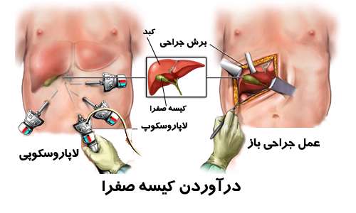 عمل جراحی کیسه صفرا