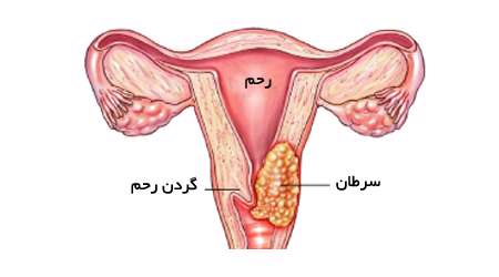 سرطان گردن رحم