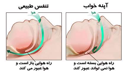 تنگی نفس در خواب