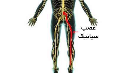 درد عصب سیاتیک