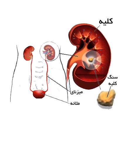نکاتی جالب درباره سنگ کلیه نکاتی جالب درباره سنگ کلیه