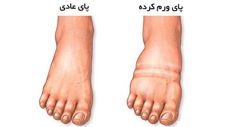 ورم پا