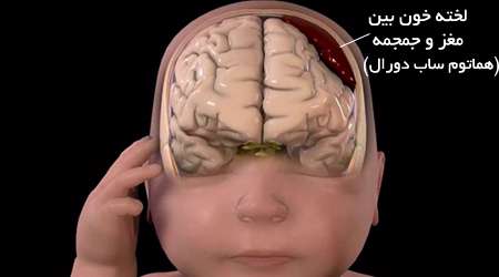 لخته خون مغز کودک