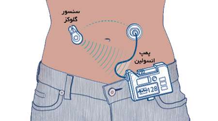 دستگاه پانکراس مصنوعی