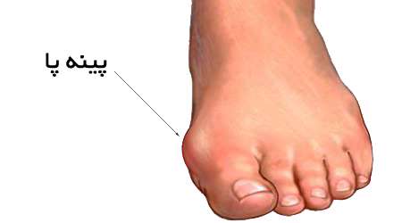 پینه پا