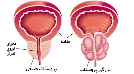 بزرگی پروستات