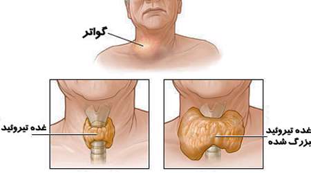گواتر