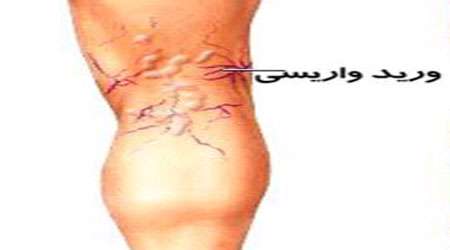 درمان واریس با مواد طبیعی