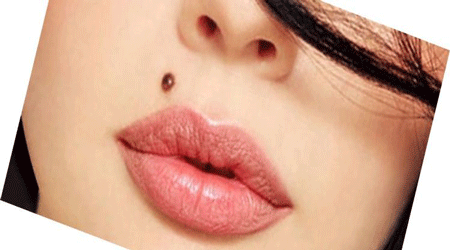 خال صورت، زیبایی، جراحی ، سرطان