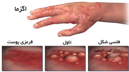 اگزما