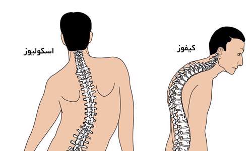 اسکولیوز و کیفوز
