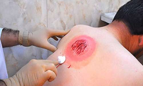 حجامت در زمستان ممنوع حجامت در زمستان ممنوع