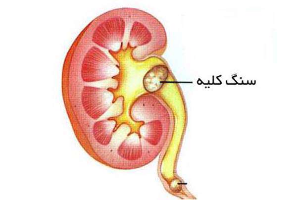 داروی موثر بر دفع سنگ کلیه، دستاورد تقدیری دوره دوم دبیرستان ابن سینا در بخش غرفه