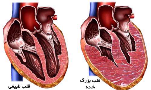 چرا قلب انسان بزرگ می شود