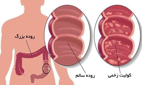 وقتی دیواره روده زخم میشود وقتی دیواره روده زخم میشود